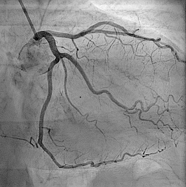 Live Coronary Angiography